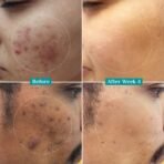 Pilgrim 10% Niacinamide Serum 30ml For Acne Marks|With 1% Zinc PCA, Salicylic & Hyaluronic Acid|Niacinamide Serum For Oily Skin, Acne-Prone, Combination, Normal Skin|Oil Control, Anti-Acne|Women & Men [AA1102/205] - Image 2